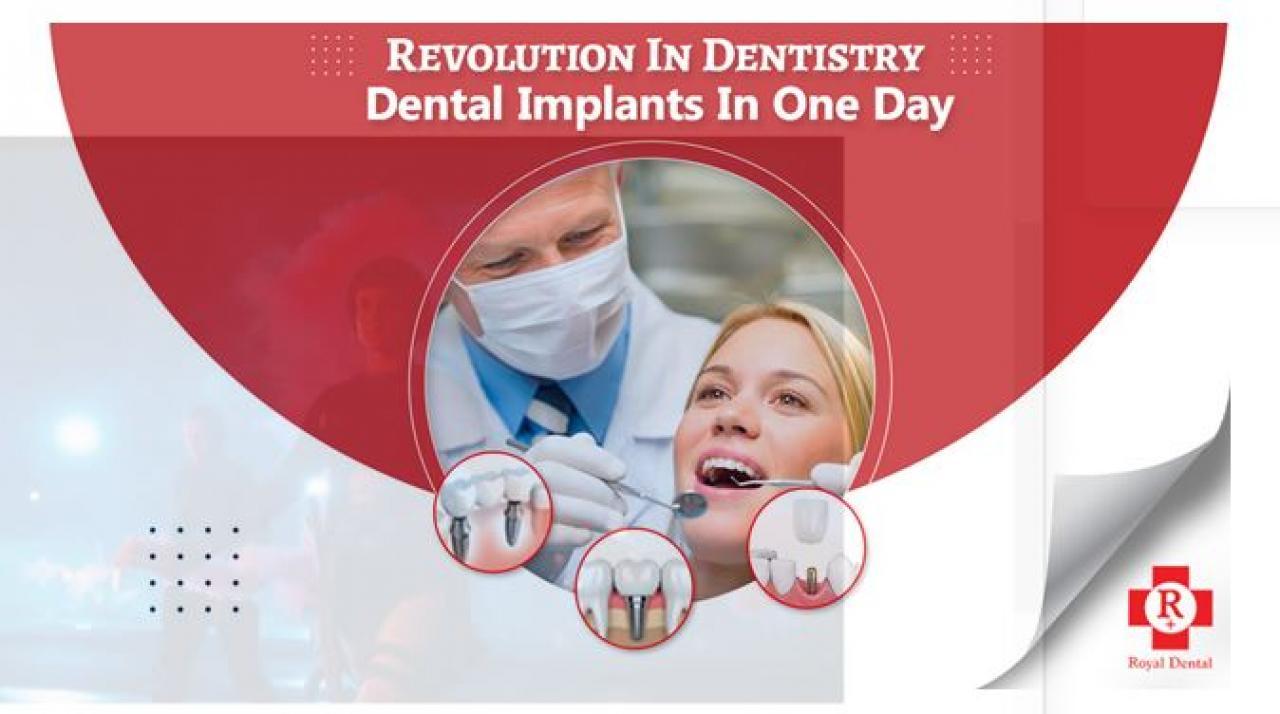રોયલ ડેન્ટલ ક્લિનિક્સમાં કાયમી દાંત સાથે ડેન્ટલ ઇમ્પ્લાન્ટ