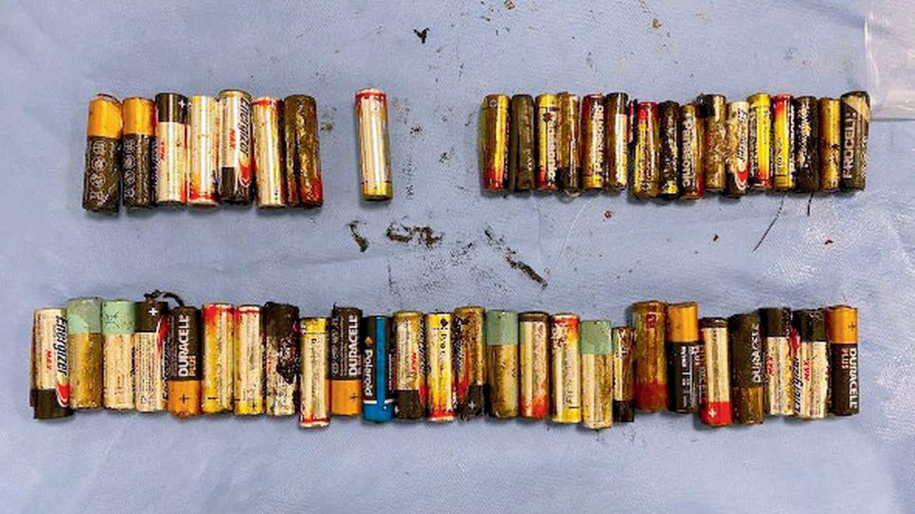 મહિલાના પેટમાંથી ૫૦ બૅટરી સેલ કાઢવામાં આવ્યા