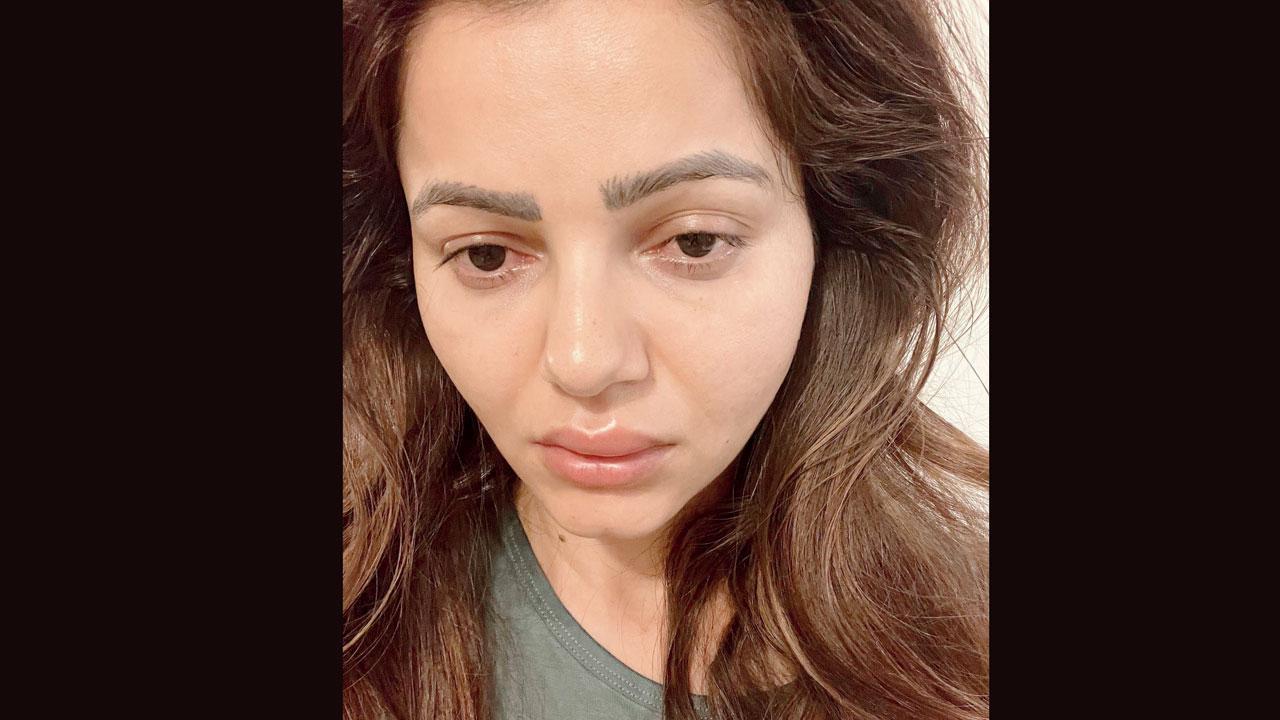 બીમારીને કારણે રુબીનાના ચહેરાના હાલ-બેહાલ