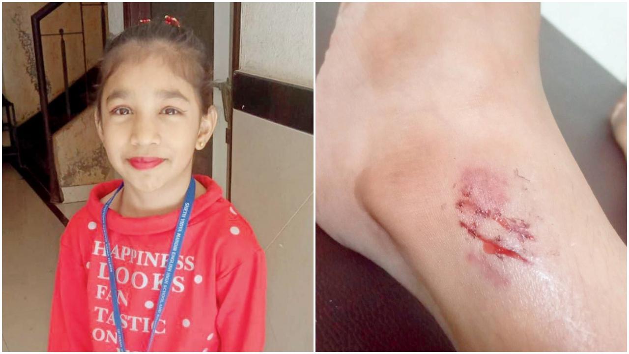 વસઈમાં રહેતી આઠ વર્ષની ગુજરાતી બાળકીને શ્વાન પગમાં કરડ્યો હતો.