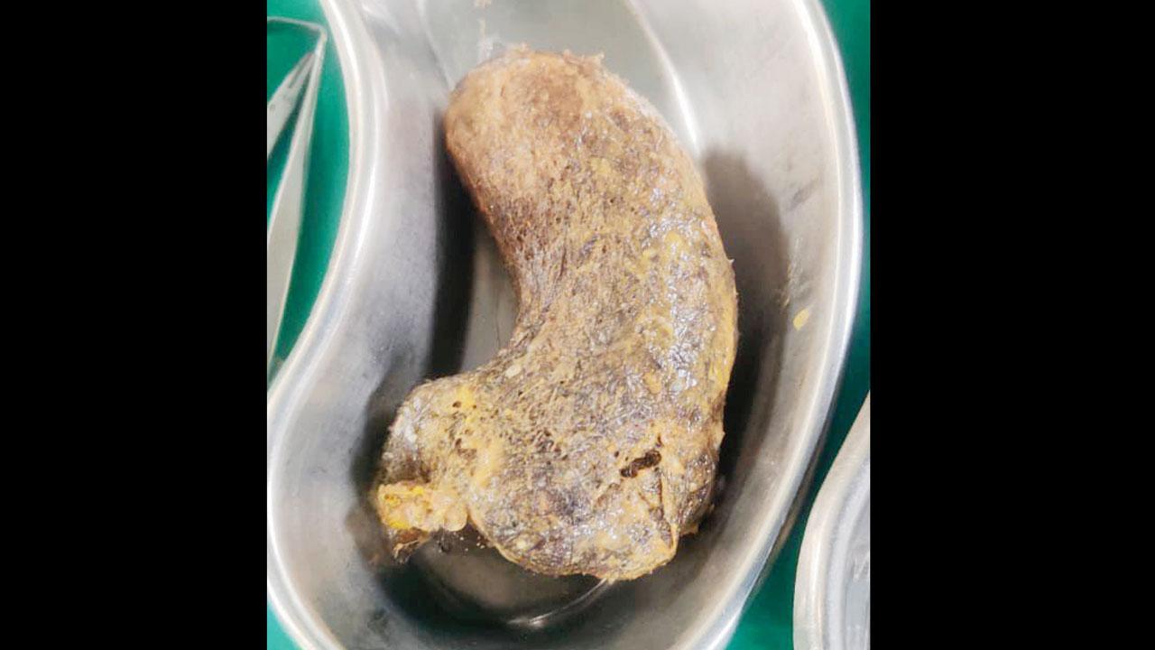 વાડિયા હૉસ્પિટલમાં સર્જરી બાદ ૧૦ વર્ષની બાળકીના પેટમાંથી ૧૦૦ ગ્રામ વાળનો ગુચ્છો નીકળ્યો હતો