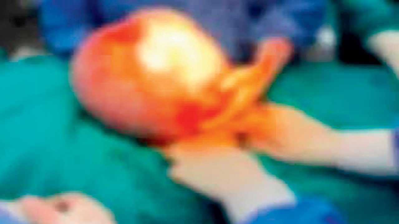 જાયન્ટ સાઇઝનું ટ્યુમર