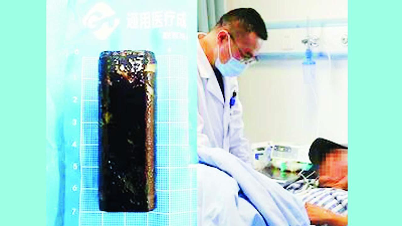 ડેન્ગ નામના ભાઈએ દારૂના નશામાં સિગારેટ સળગાવવા માટેનું લાઇટર મોંમાં નાખી દીધું