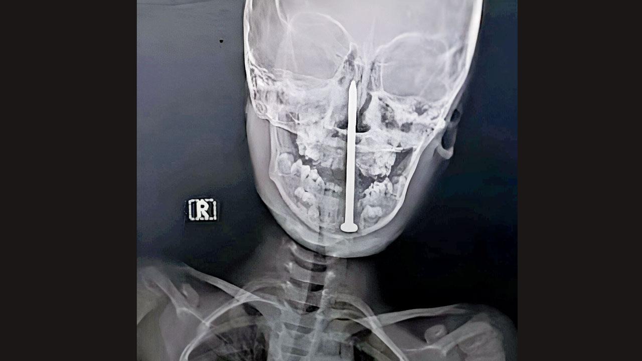 બાળકની ગરદનના પાછળના ભાગમાં આઠ સેન્ટિમીટર લાંબો લોખંડનો ખીલો ઘૂસી ગયો હતો
