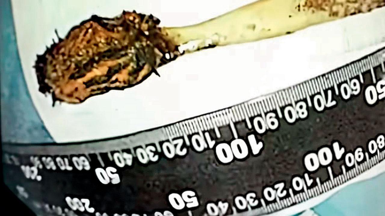 બાળપણમાં ગળાઈ ગયેલું ૧૭ સેન્ટિમીટરનું ટૂથબ્રશ બાવન વર્ષ સુધી પેટમાં રહ્યું