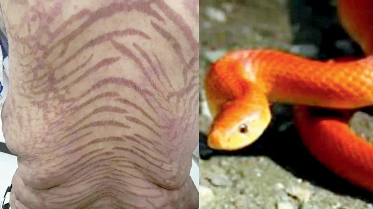 હર્બલ ચાઇનીઝ ક્રીમ લગાવવાથી મહિલાની ત્વચા સાપ જેવી થઈ ગઈ