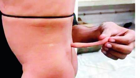 સૂર્યાંશ નામના છોકરાને કમર પર એક પૂંછડી ઊગી