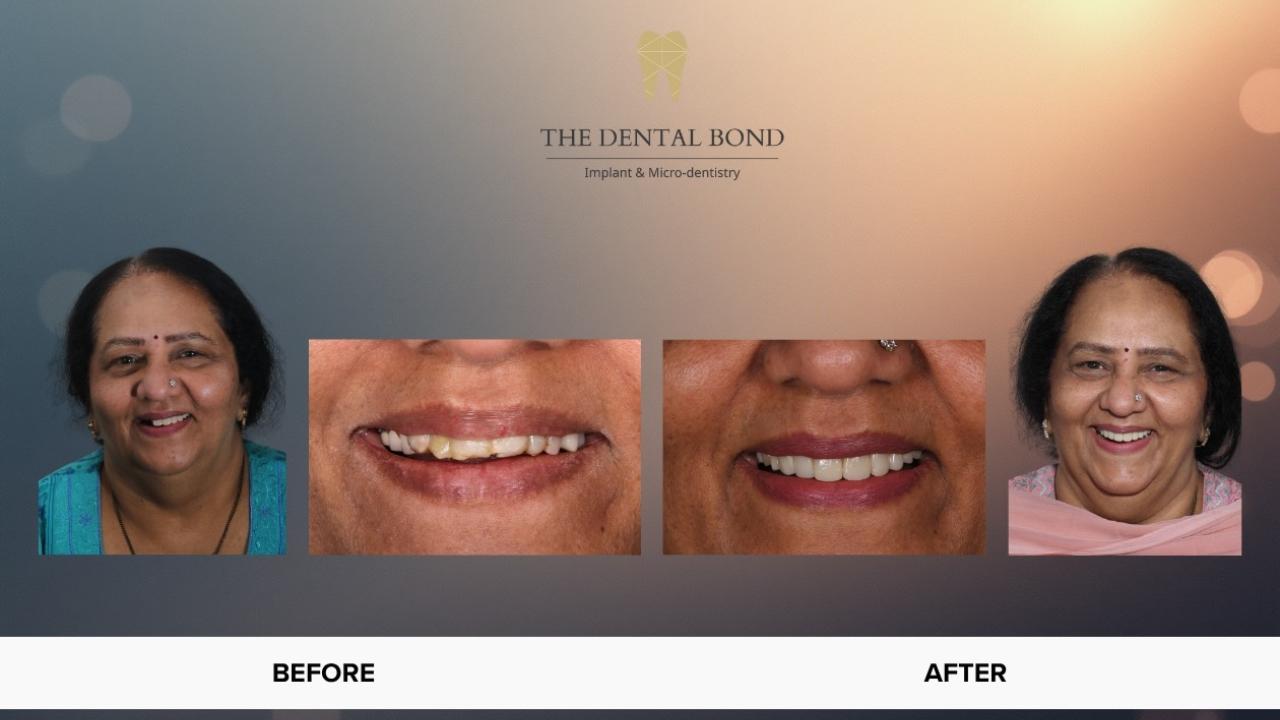 ધ ડેન્ટલ બોન્ડ દ્વારા પ્રભાવશાળી ડેન્ટલ રૂપાંતર