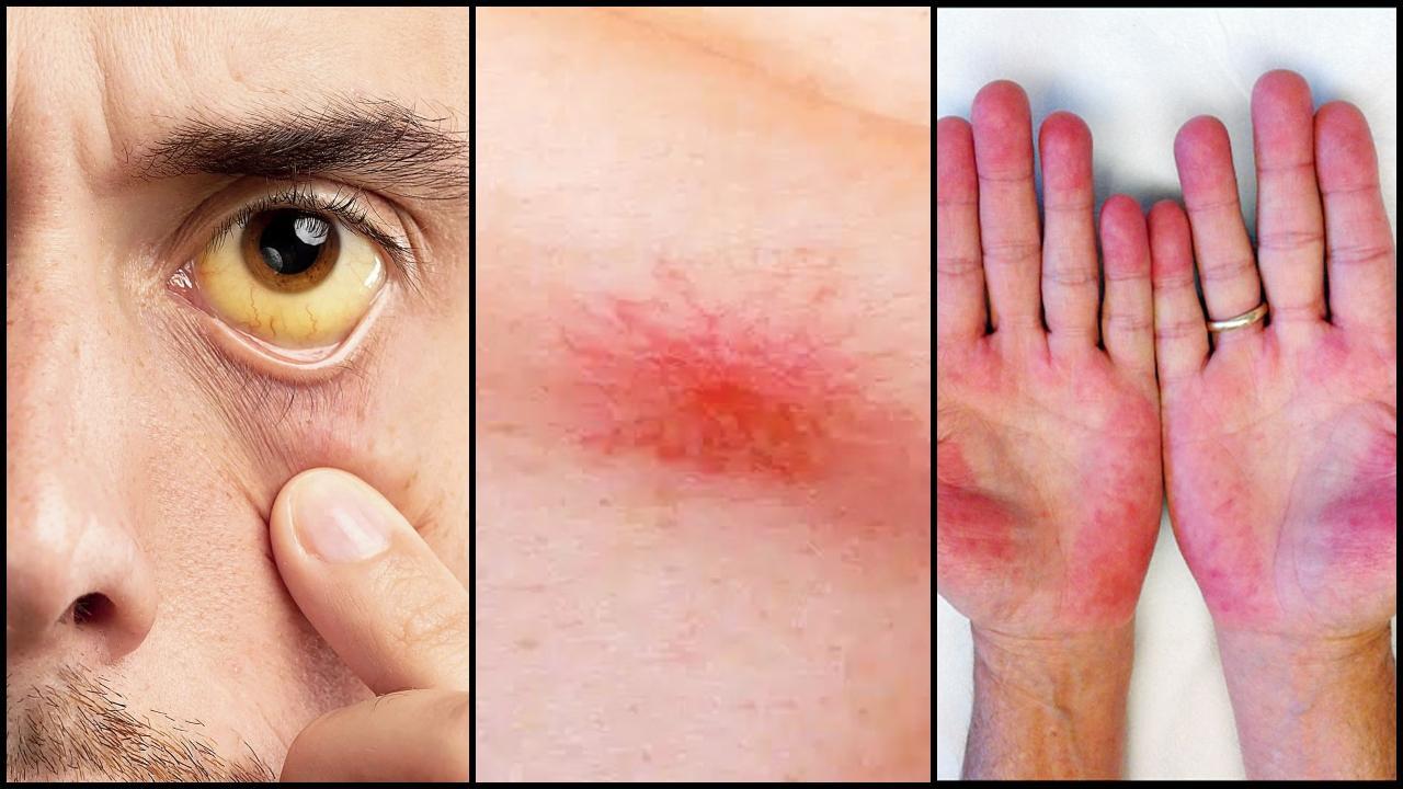 આંખો પીળાશ પડતી દેખાય છે, કરોળિયાના પગ જેવા આકારનાં ચાઠાં પડે છે, હાથની હથેળીઓ લાલ થઈ જાય છે