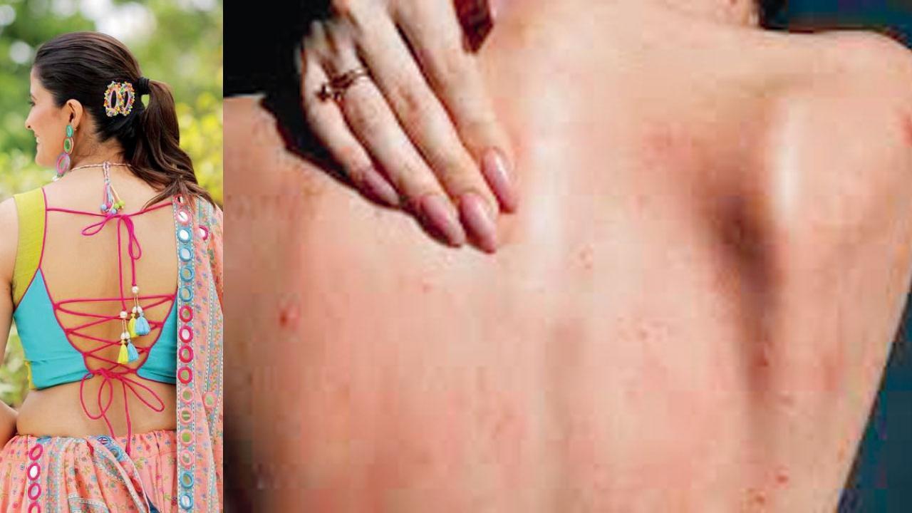 નવરાત્રિમાં બૅકલેસ ટૉપ્સ પહેરતાં પહેલાં પીઠની કાળજી લેજો