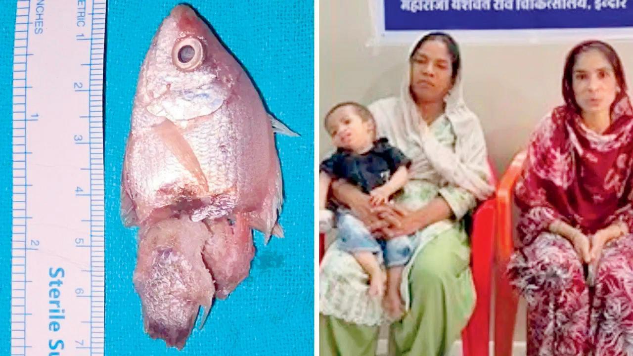 એક વર્ષના માસૂમે ત્રણ ઇંચની જીવતી માછલી  ગળી લેતાં ગળામાં ફસાઈ ગઈ