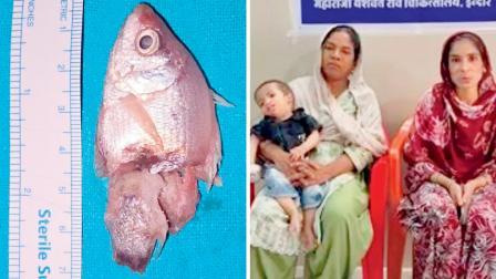 એક વર્ષના માસૂમે ત્રણ ઇંચની જીવતી માછલી  ગળી લેતાં ગળામાં ફસાઈ ગઈ