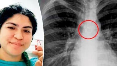 એક્સ-રેમાં ફેફસાંની વચ્ચે તેની નાકની ચૂંક ફસાયેલી જોવા મળી હતી