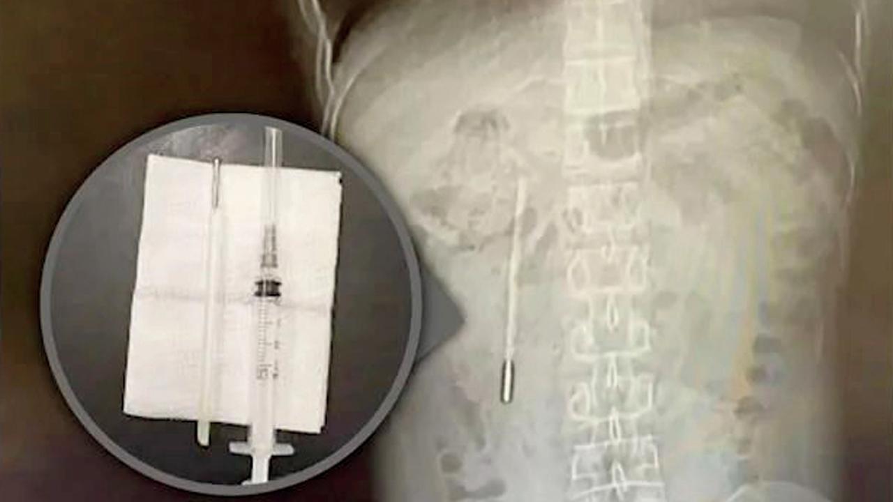 પેટમાં દુખાવાની ફરિયાદ લઈને ગયેલા યુવાનના પેટમાંથી નીકળ્યું થર્મોમીટર