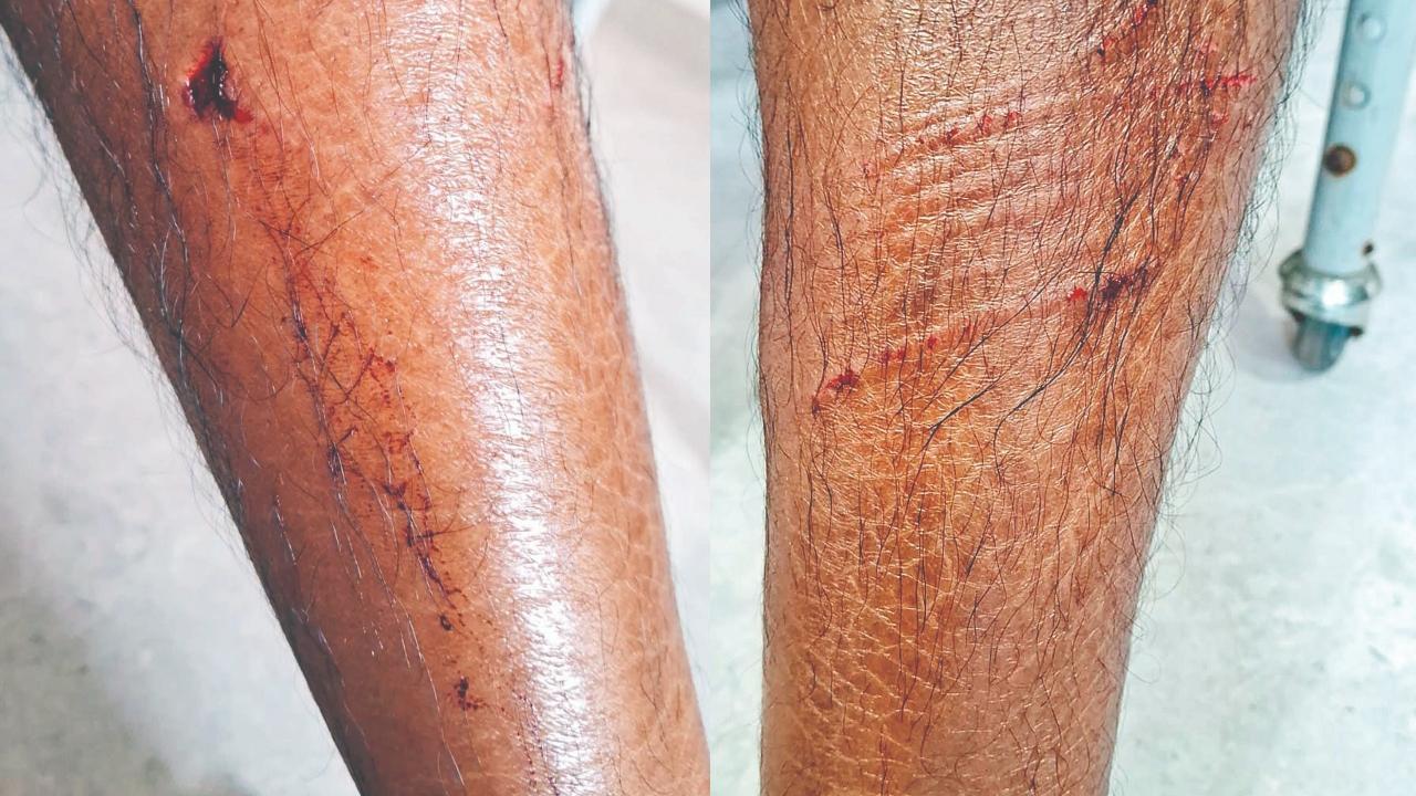 કૂતરો કરડવાથી ઘાટકોપરના જુબીન શાહના જમણા પગ પર પડેલો ઘા અને ઉઝરડા.