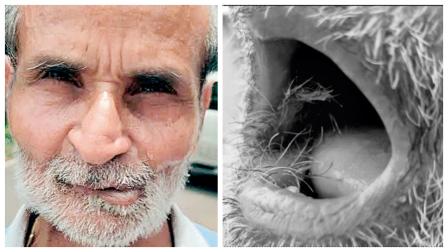 મોઢામાં કૅન્સરની સર્જરી કર્યા પછી ગલોફામાં વાળ ઊગવા લાગ્યા