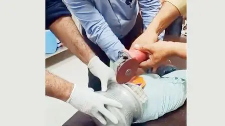 હૉસ્પિટલમાં કામ કરતા પ્લમ્બરને બોલાવવામાં આવ્યો. વાસણ કાપતી વખતે વાસણ અને બાળકના માથા વચ્ચે ભીનું કપડું અને લાકડીની ‌શીટ ભરાવી દીધી