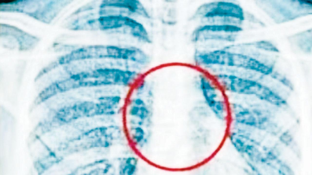 CT સ્કૅન કર્યો તો ખબર પડી કે એક પિન તેના ફેફસાના વાલ્વની પાસે આડી ફસાઈ ગઈ છે