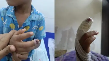 બાળકને હૉસ્પિટલમાં સારવાર આપવામાં આવી હતી 