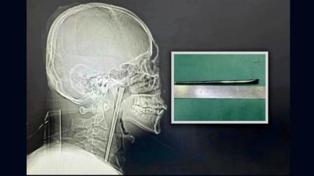  ૮ વર્ષ સુધી લાંબી સ્ટિક ગળામાં ભરાઈ રહી 