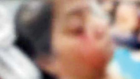 પથ્થર વાગતાં ગંભીર ઈજા પામેલી મહિલા.