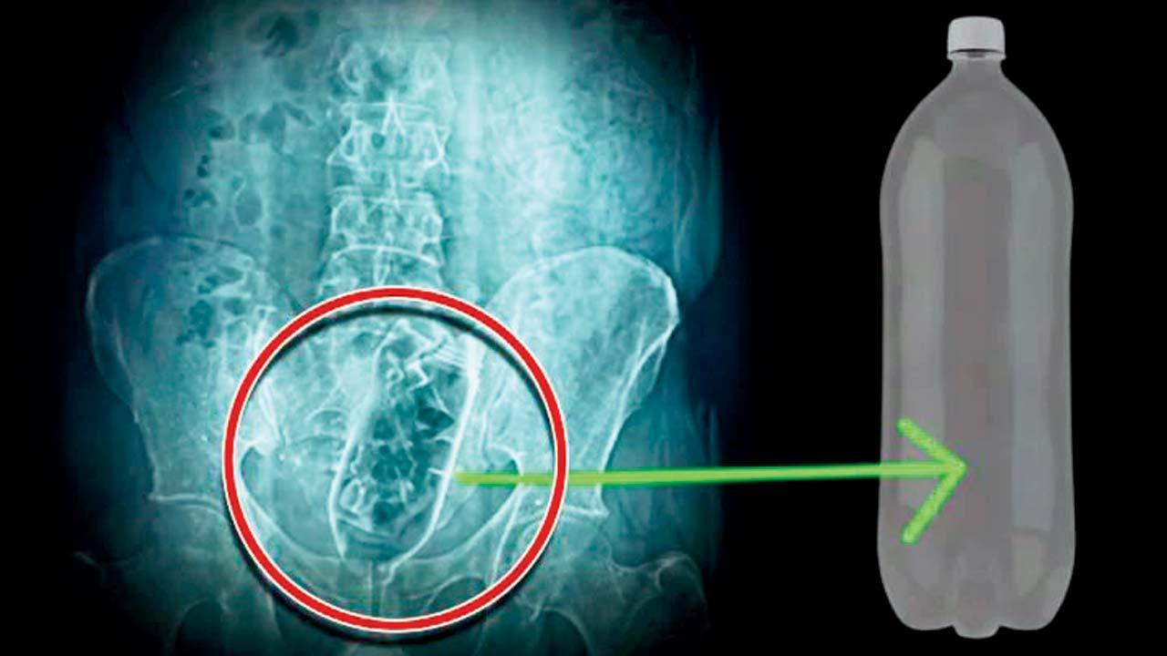  ડૉક્ટરોએ એક્સ-રે કર્યો તો ખબર પડી કે પાણીની બૉટલ મળાશયમાં ખાસ્સી ઊંડે સુધી ઊતરી ગઈ છે.