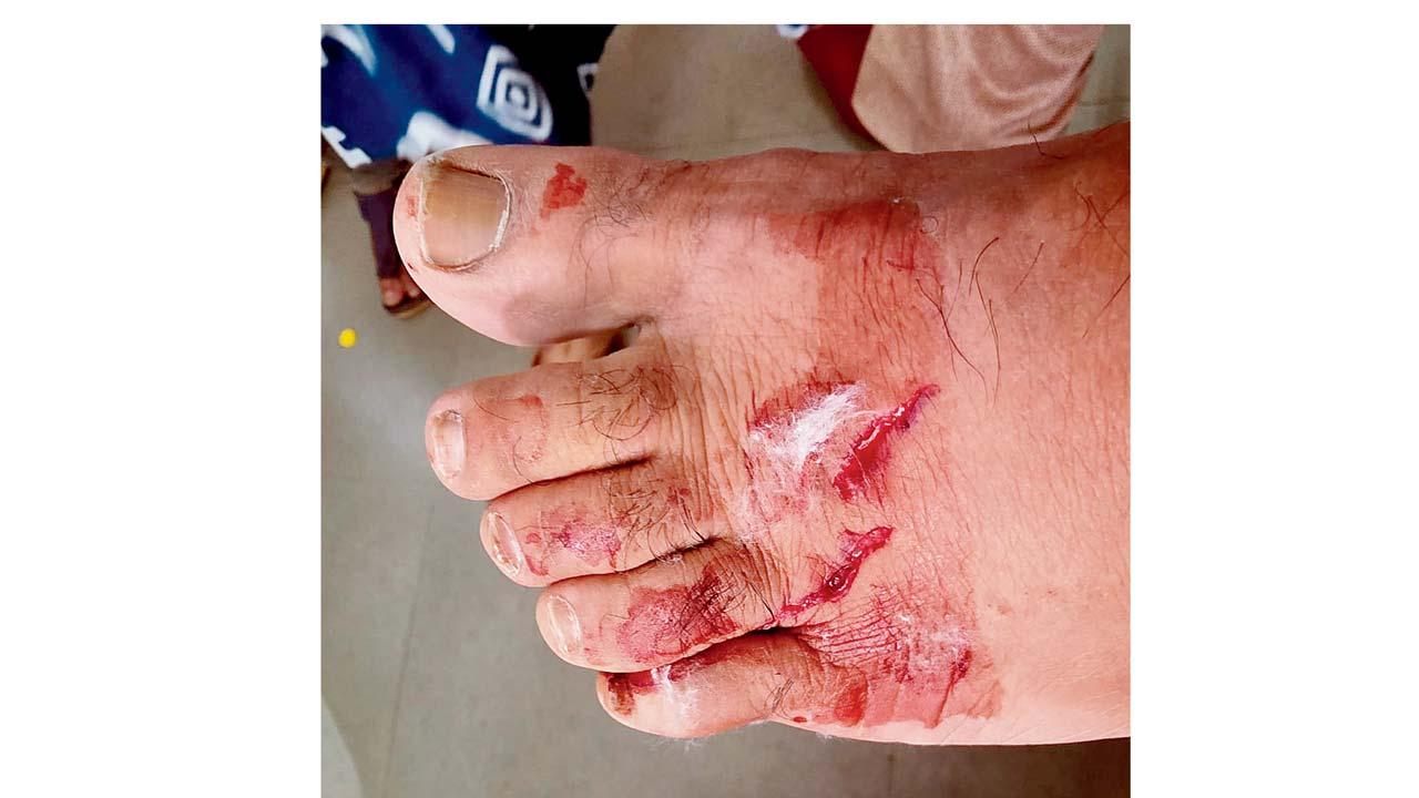 કૂતરો કરડ્યા પછી હિતેન ગડાનો પગ.
