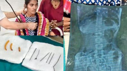 ડૉક્ટરો માટે આંતરડાંમાં સોય શોધવી મોટો પડકાર હતો