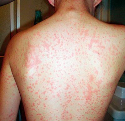 અળાઈથી છુટકારો કેવી રીતે મેળવવો?