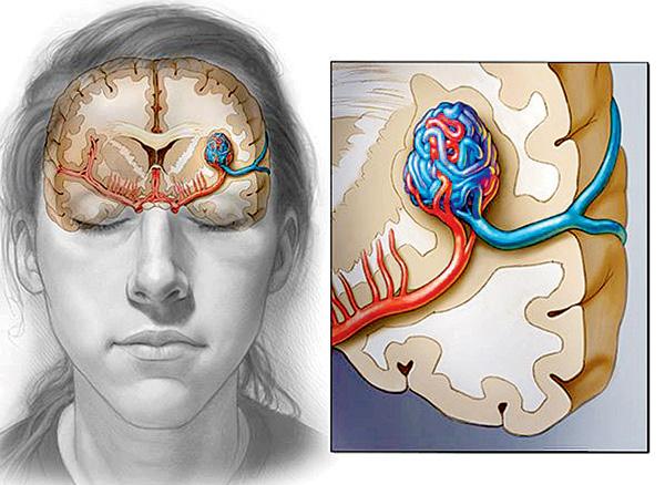 બ્રેઇનમાં હૅમરેજ કે સ્ટ્રોકનું કારણ બનતો રોગ આર્ટરીઓવીનસ માલફૉર્મેશન