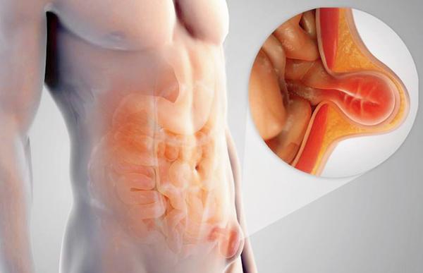 તમને હર્નિયા થાય તો ઑપરેશન ટાળો નહીં